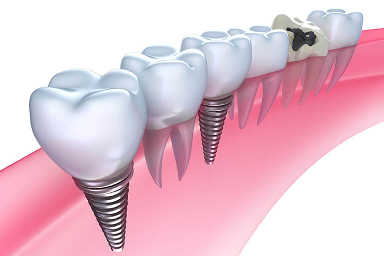 インプラント治療で、天然の歯に最も近い見た目と機能を。